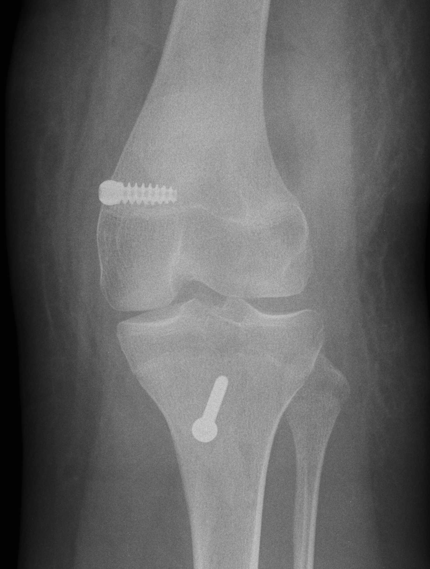 Patella Instability MPFL and TTT